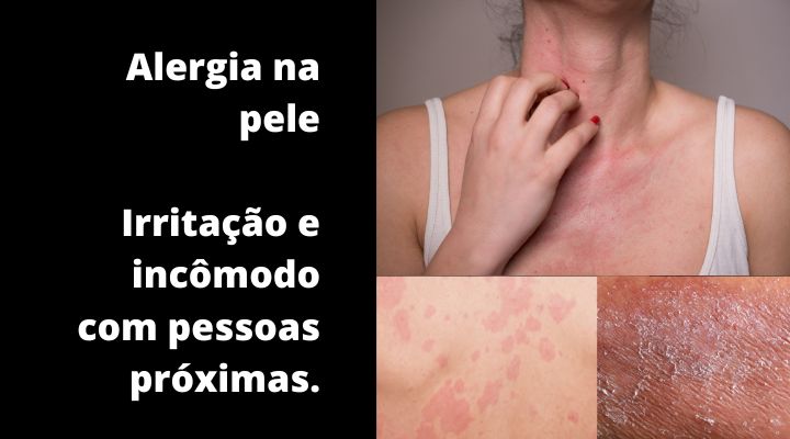 BLOG 20 - ALERGIA NA PELE - alguém próximo te irrita e incomoda